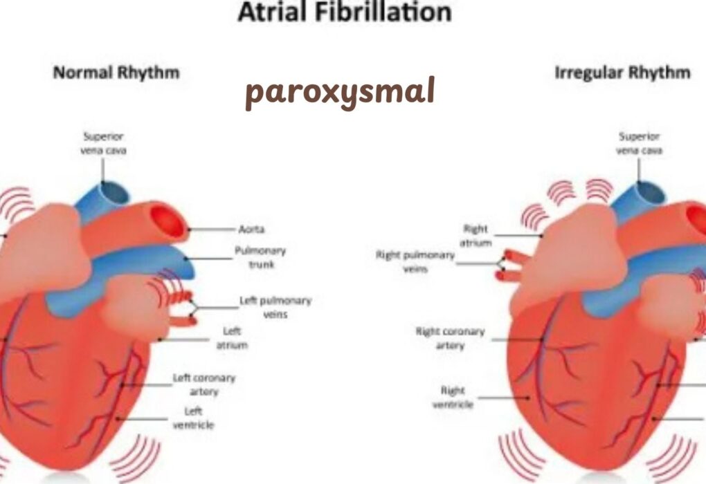 Paroxysmal Atrial Fibrillation ICD 10