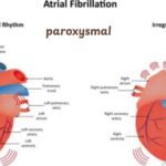 Paroxysmal Atrial Fibrillation ICD 10