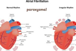 Paroxysmal Atrial Fibrillation ICD 10