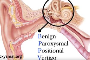 Benign Paroxysmal Positional Vertigo