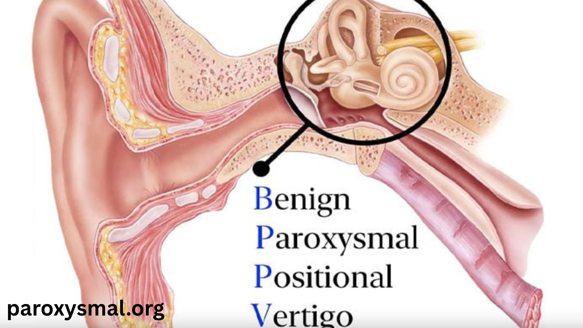 Benign Paroxysmal Positional Vertigo
